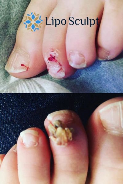 Wart removal customer results from Lipo Sculpt Blackpool